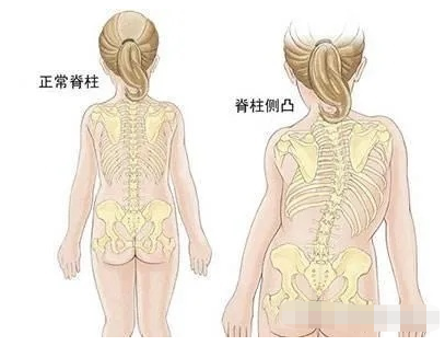 【骨伤护理科普】小心！你家孩子也许被“脊柱侧弯”盯上了…